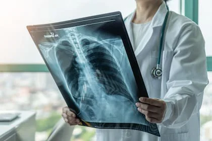 Los investigadores identificaron un vínculo más marcado con tumores de pulmón, del tracto gastrointestinal y de útero